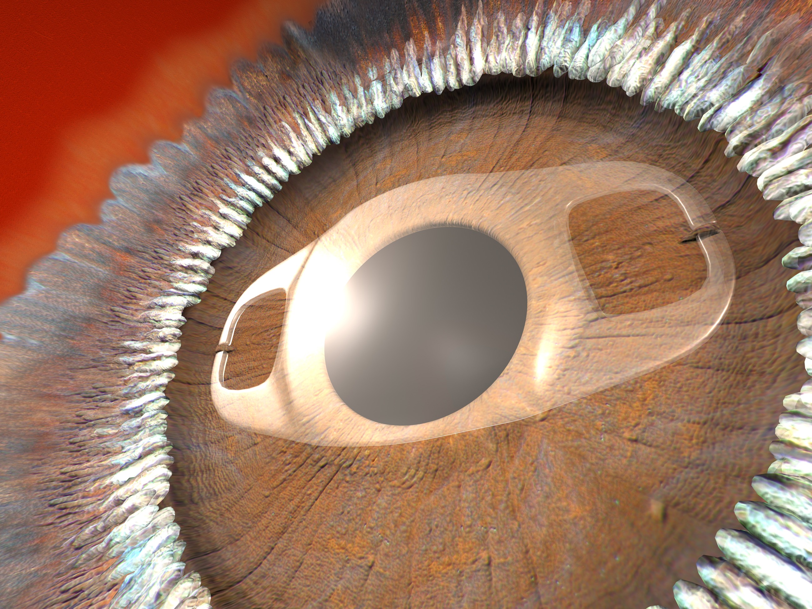 Artisan lens — retropupillary fixation