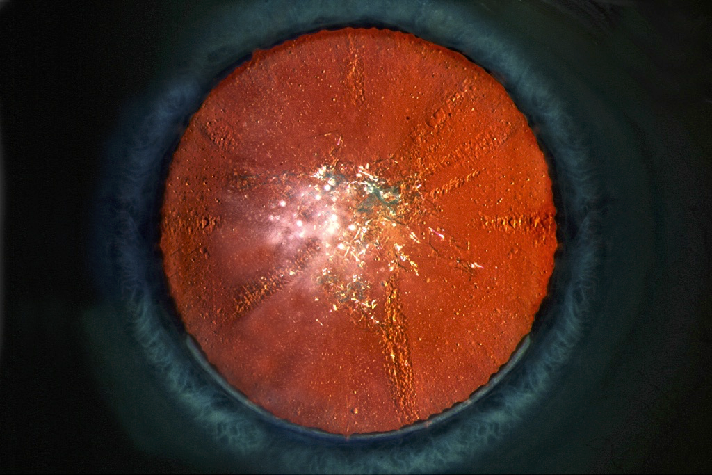 Christmas tree cataract
