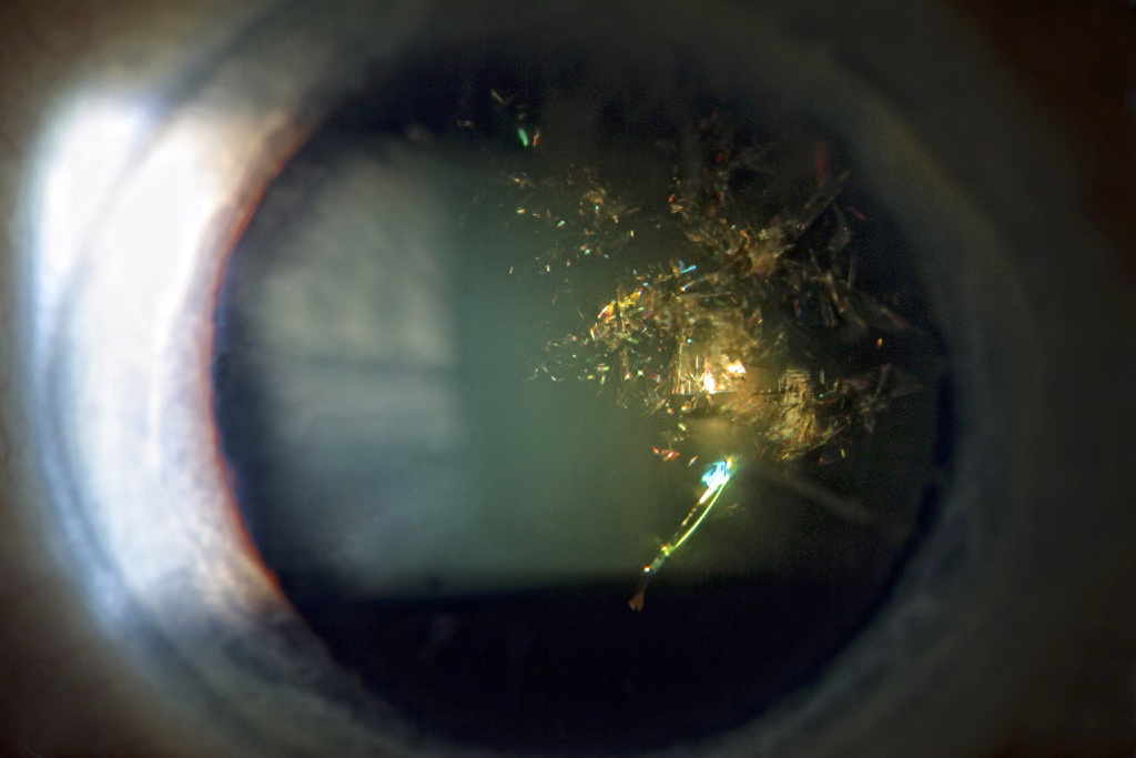 Christmas tree cataract