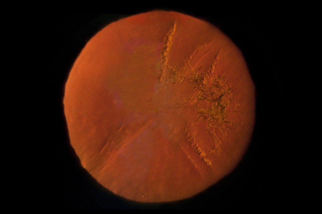 Christmas tree cataract