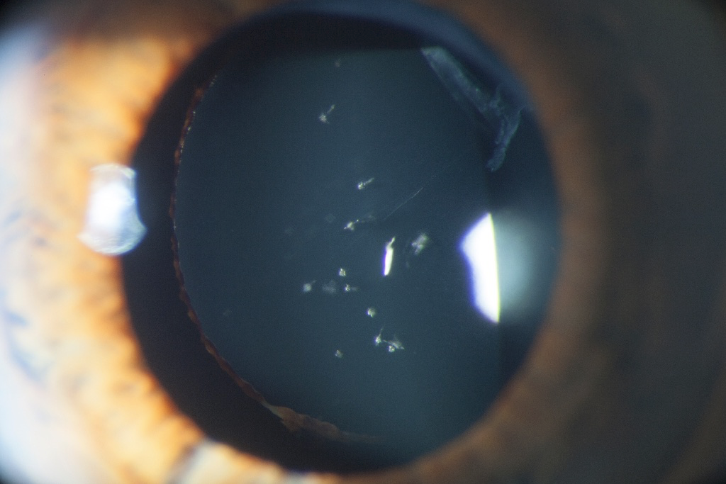 Status post YAG laser treatment